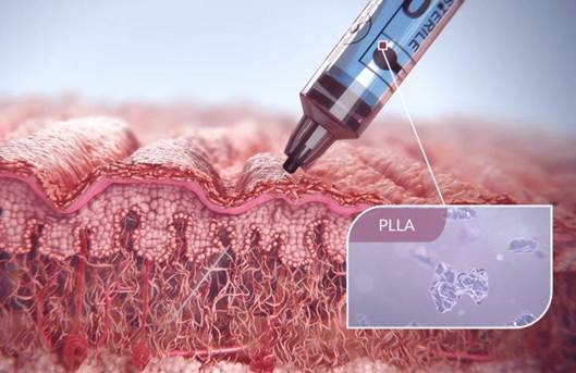 PLLA 성분이 피부에 주입되어 콜라겐 생성을 유도하는 과정을 나타낸 그림